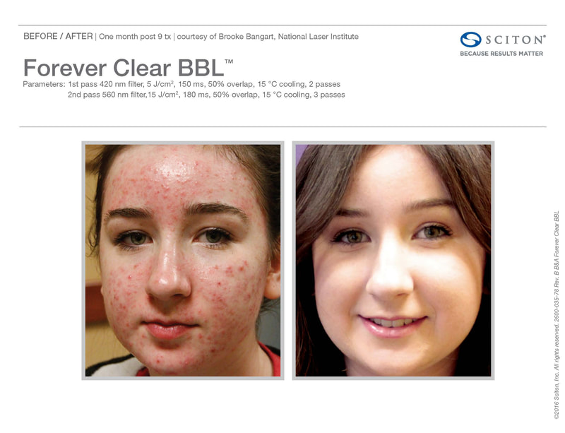 Forever Clear® BBL for acne