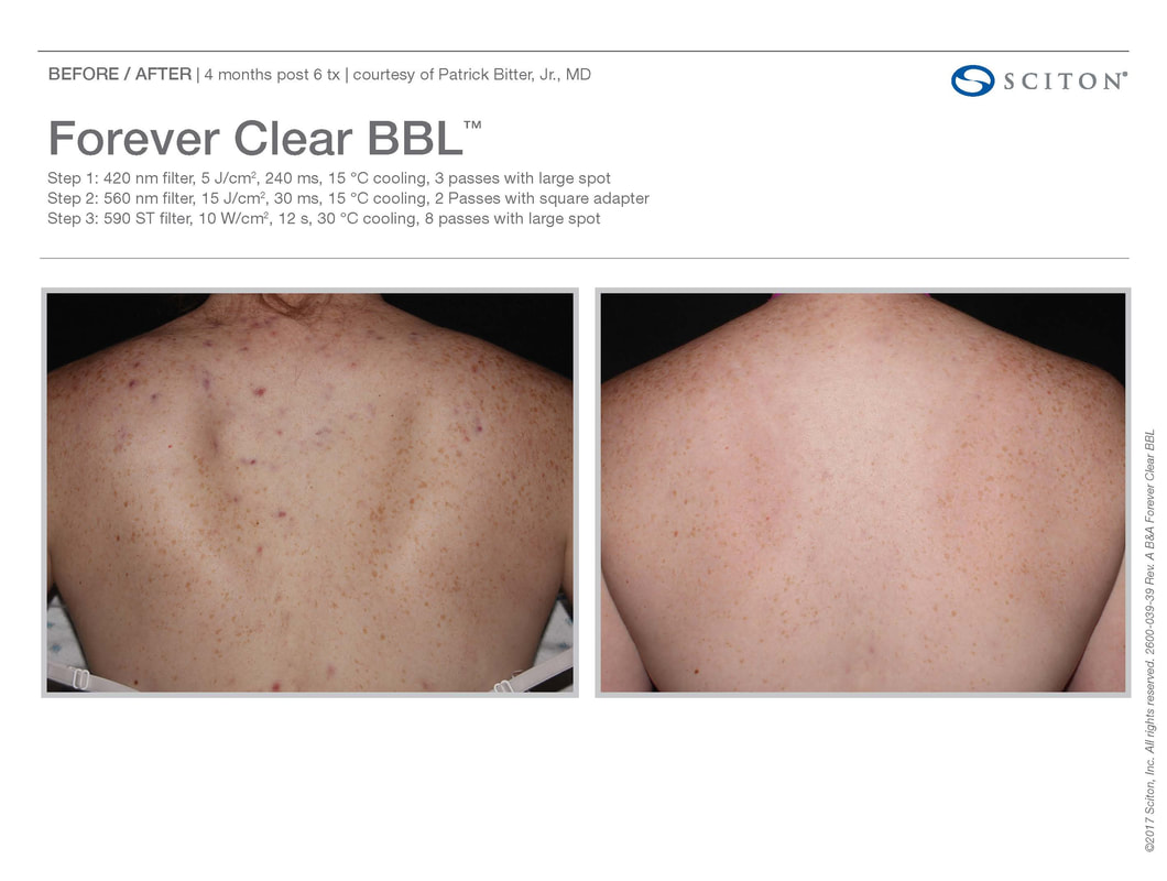 Forever Clear® BBL for acne