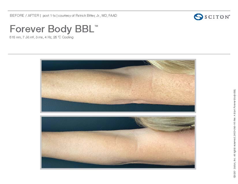 Forever Young Body before and after treatment results
