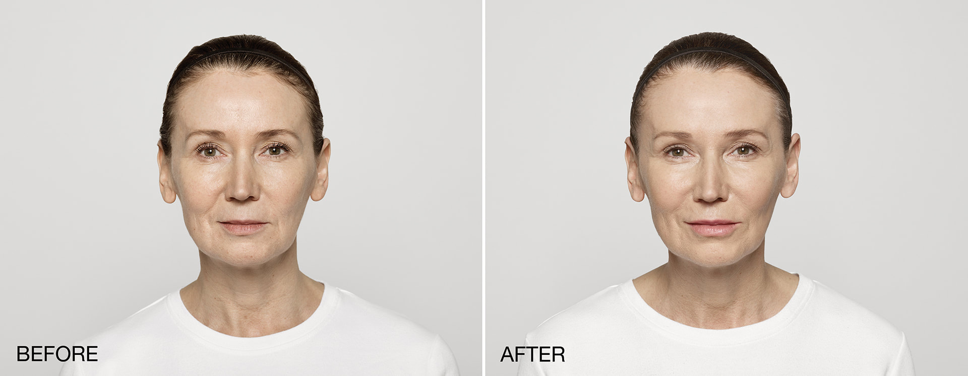 Restylane Treatment Before & After
