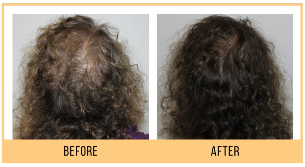 Hydrafacial Keravive Hair Restoration